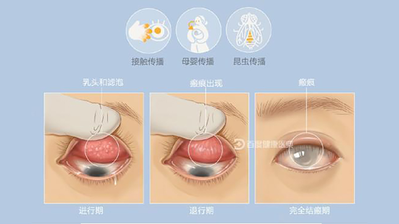 Mắt hột có phải do cát lọt vào mắt?